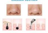 Black head remover skin care cash on delivery available by Waseem Raza