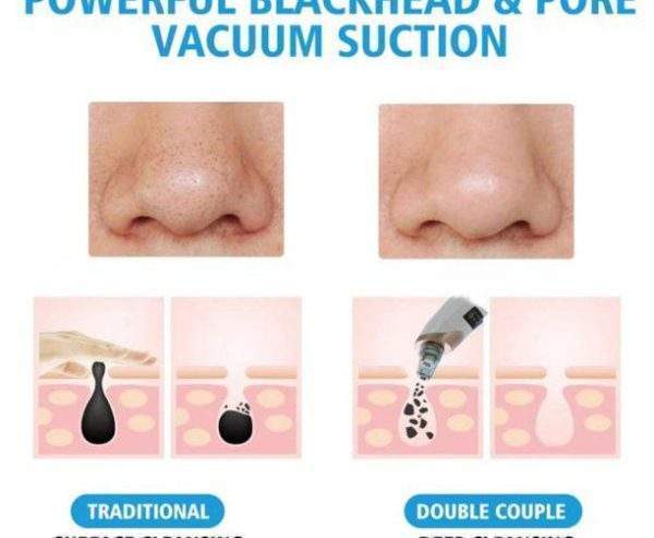 Black head remover skin care cash on delivery available by Waseem Raza