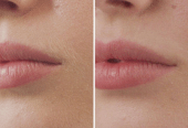 Hair removal by Muhammad Kabeer